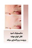 قطره بر طرف کننده منافذ لانبنا