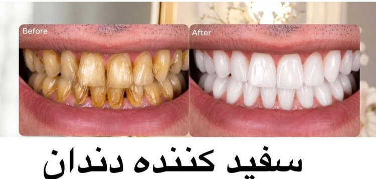 موس دندان سفید کننده خوشبو کننده و جرمگیر